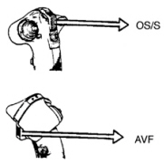 SS  med OS/S-bygel och AVF-knapp